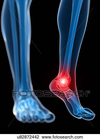 Painful ankle, artwork View Large Illustration Drawing - Painful ankle, artwork. Fotosearch
