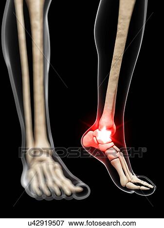 Stock Illustration - Painful ankle, artwork. Fotosearch