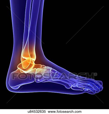 Painful ankle, artwork View Large Illustration Stock Illustration - Painful ankle, artwork. Fotosearch