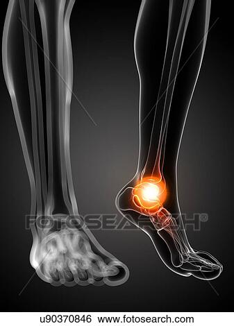 Painful ankle, artwork View Large Illustration Stock Illustration - Painful ankle, artwork. Fotosearch