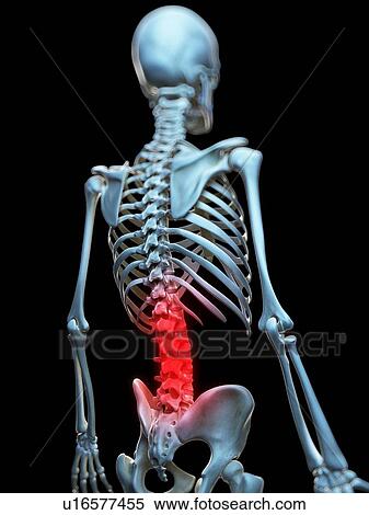 Painful back, artwork View Large Illustration Stock Illustration - Painful back, artwork. Fotosearch