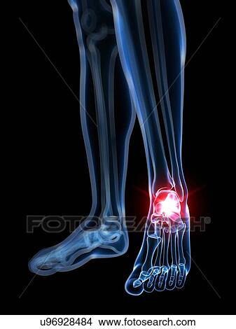 Painful foot, artwork View Large Illustration Stock Illustration - Painful foot, artwork. Fotosearch