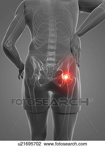 Painful hip joint, artwork View Large Illustration Drawing - Painful hip joint, artwork. Fotosearch
