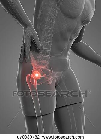 Painful hip joint, artwork View Large Illustration Drawing - Painful hip joint, artwork. Fotosearch