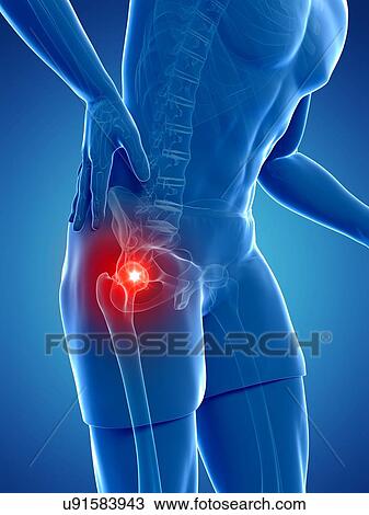 Drawing - Painful hip joint, artwork. Fotosearch