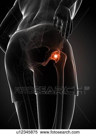 Stock Illustration - Painful hip joint, artwork. Fotosearch
