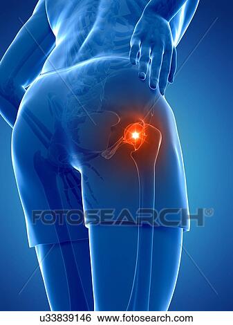 Stock Illustration - Painful hip joint, artwork. Fotosearch