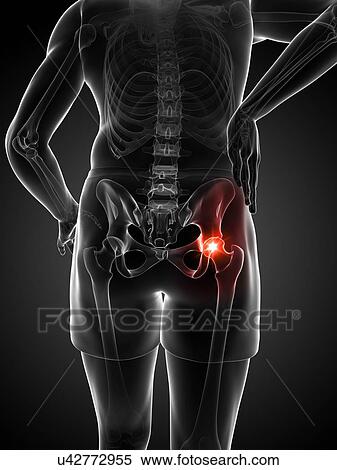Painful hip joint, artwork View Large Illustration Stock Illustration - Painful hip joint, artwork. Fotosearch