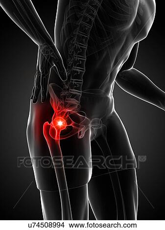 Painful hip joint, artwork View Large Illustration Stock Illustration - Painful hip joint, artwork. Fotosearch
