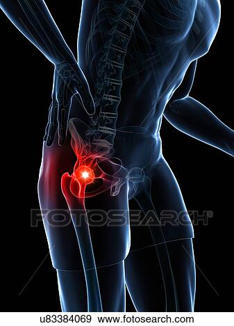 Painful hip joint, artwork View Large Illustration Stock Illustration - Painful hip joint, artwork. Fotosearch