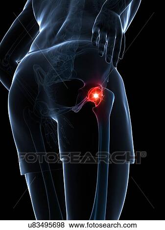 Stock Illustration - Painful hip joint, artwork. Fotosearch