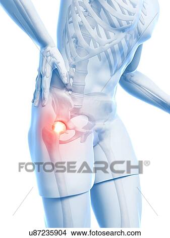 Stock Illustration - Painful hip joint, artwork. Fotosearch