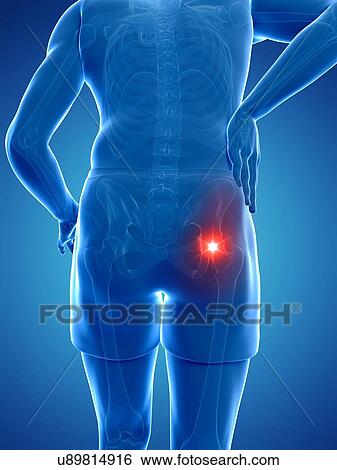 Painful hip joint, artwork View Large Illustration Stock Illustration - Painful hip joint, artwork. Fotosearch