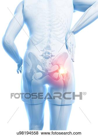 Painful hip joint, artwork View Large Illustration Stock Illustration - Painful hip joint, artwork. Fotosearch