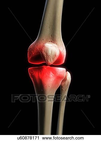 Clip Art - Painful knee, artwork. Fotosearch