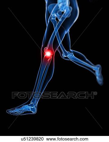 Clipart - Painful knee, artwork. Fotosearch
