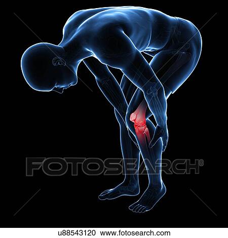 Clipart - Painful knee, artwork. Fotosearch
