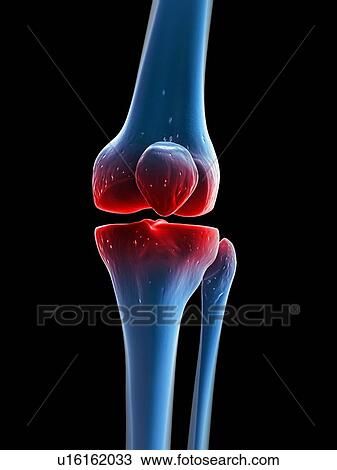 Drawing - Painful knee, artwork. Fotosearch