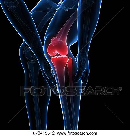 Drawing - Painful knee, artwork. Fotosearch