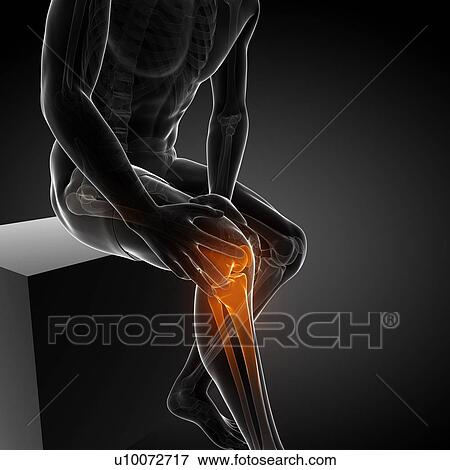 Painful knee, artwork View Large Illustration Stock Illustration - Painful knee, artwork. Fotosearch