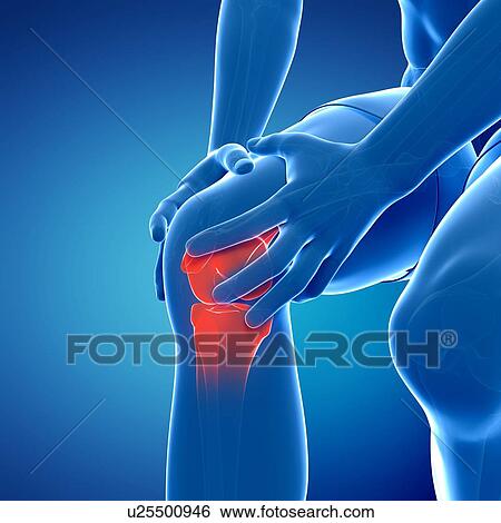 Stock Illustration - Painful knee, artwork. Fotosearch