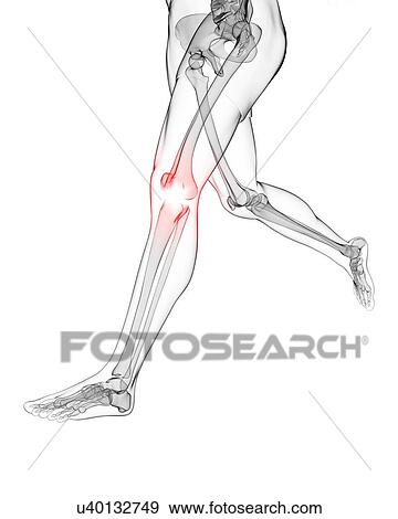 Stock Illustration - Painful knee, artwork. Fotosearch