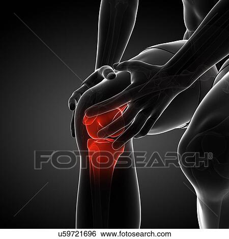 Painful knee, artwork View Large Illustration Stock Illustration - Painful knee, artwork. Fotosearch