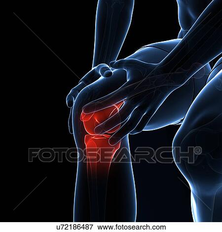 Painful knee, artwork View Large Illustration Stock Illustration - Painful knee, artwork. Fotosearch