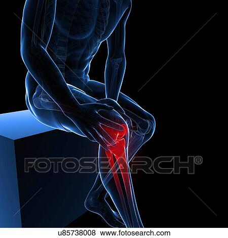 Painful knee, artwork View Large Illustration Stock Illustration - Painful knee, artwork. Fotosearch