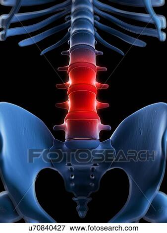 Stock Illustration - Painful lumbar spine, artwork. Fotosearch