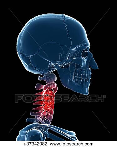 Drawing - Painful neck, artwork. Fotosearch
