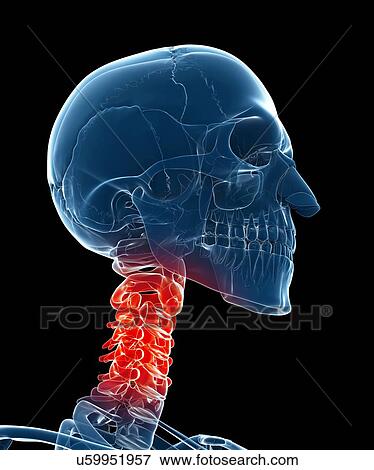 Painful neck, artwork View Large Illustration Stock Illustration - Painful neck, artwork. Fotosearch