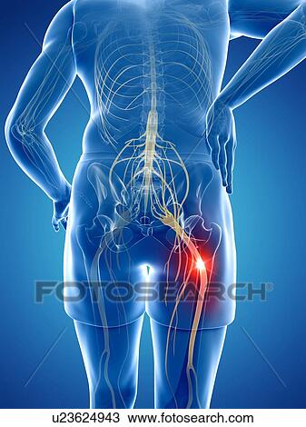 Drawing - Painful sciatic nerve, artwork. Fotosearch