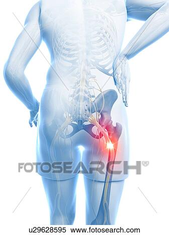 Painful sciatic nerve, artwork View Large Illustration Stock Illustration - Painful sciatic nerve, artwork. Fotosearch
