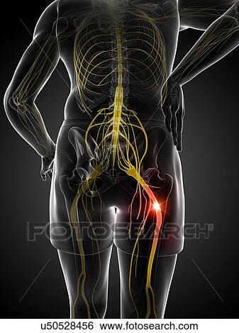 Stock Illustration - Painful sciatic nerve, artwork. Fotosearch