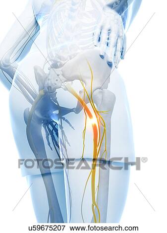 Painful sciatic nerve, artwork View Large Illustration Stock Illustration - Painful sciatic nerve, artwork. Fotosearch