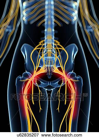 Painful sciatic nerve artwork View Large Illustration Stock Illustration - Painful sciatic nerve artwork. Fotosearch
