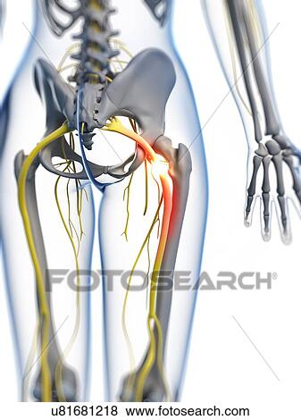 Stock Illustration - Painful sciatic nerve, artwork. Fotosearch