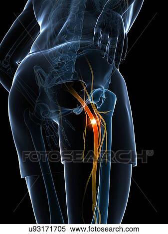 Stock Illustration - Painful sciatic nerve, artwork. Fotosearch