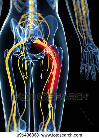 Painful sciatic nerve, artwork View Large Illustration Stock Illustration - Painful sciatic nerve, artwork. Fotosearch