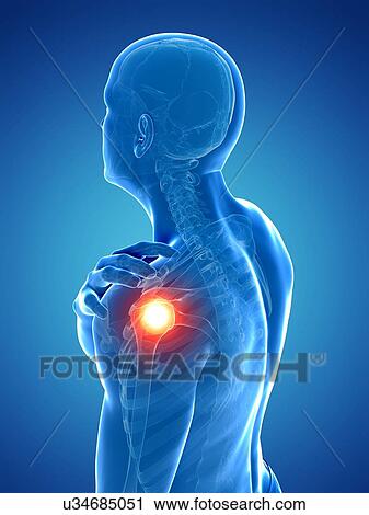 Painful shoulder, artwork View Large Illustration Clip Art - Painful shoulder, artwork. Fotosearch