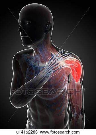 Painful shoulder, artwork View Large Illustration Drawing - Painful shoulder, artwork. Fotosearch