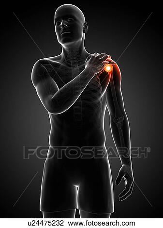 Painful shoulder, artwork View Large Illustration Drawing - Painful shoulder, artwork. Fotosearch