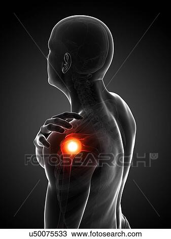 Drawing - Painful shoulder, artwork. Fotosearch