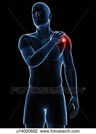 Painful shoulder, artwork View Large Illustration Drawing - Painful shoulder, artwork. Fotosearch