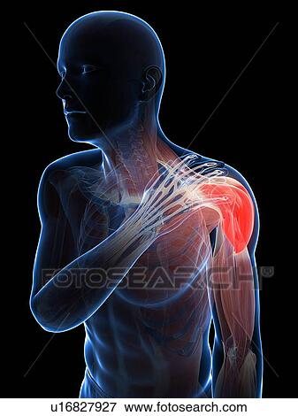 Stock Illustration - Painful shoulder, artwork. Fotosearch