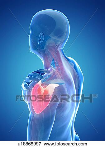 Painful shoulder, artwork View Large Illustration Stock Illustration - Painful shoulder, artwork. Fotosearch