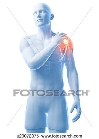 Stock Illustration - Painful shoulder, artwork. Fotosearch