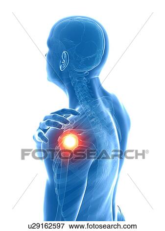 Painful shoulder, artwork View Large Illustration Stock Illustration - Painful shoulder, artwork. Fotosearch