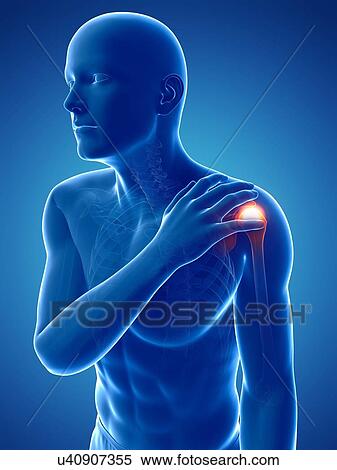 Stock Illustration - Painful shoulder, artwork. Fotosearch